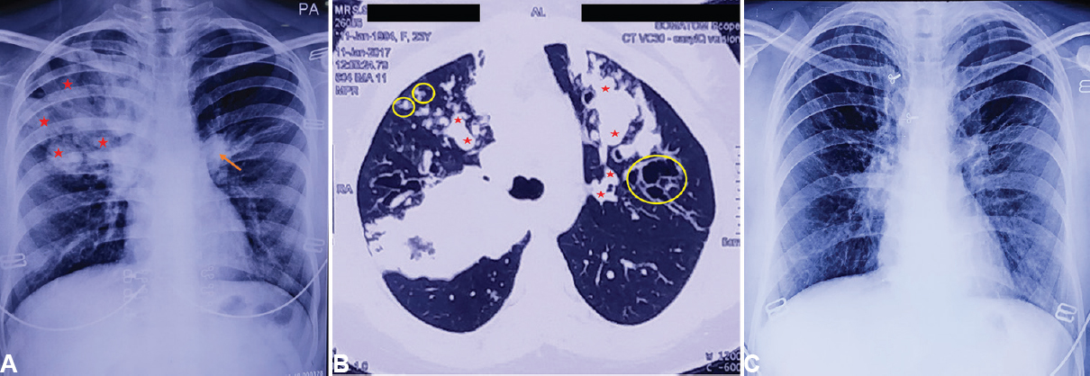 (A) Pre-treatment chest X-ray (posteroanterior view) and (B) high-resolution computed tomography chest showing opacities (asterisks, arrows and circles) in both lung fields due to mucocoeles (right lung>left lung). (C) Post-treatment chest X-ray (posteroanterior view) showing almost clearing of opacities.
